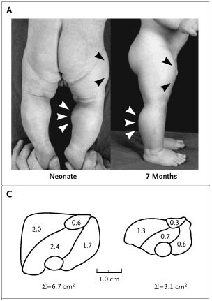 Child with mutation in the myostatin gene